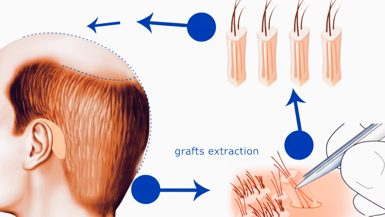 What Is a Hair Graft? Complete Guide for Hair Transplant Patients