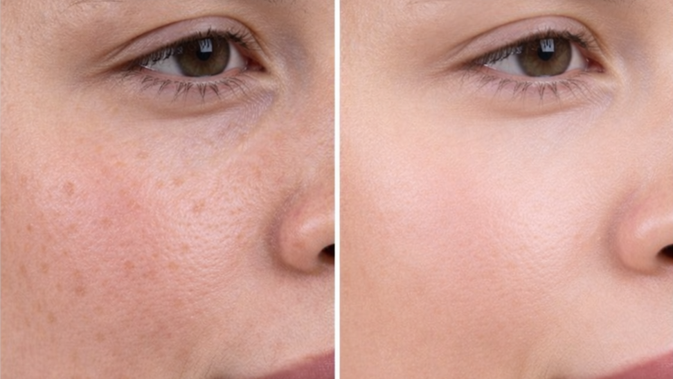 Skin Polishing Treatment in RT Nagar